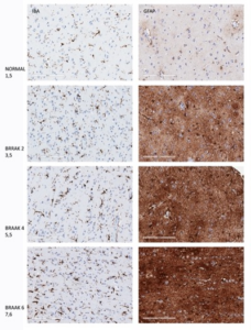 PFM-Figure-2.-Changes-in-staining-intensity-and-cell-morphology-at-different-stages-of-AD-228x300