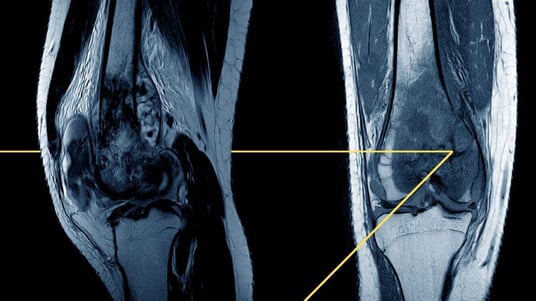 FDA Approves Breakthrough Cell Therapy for Synovial Sarcoma